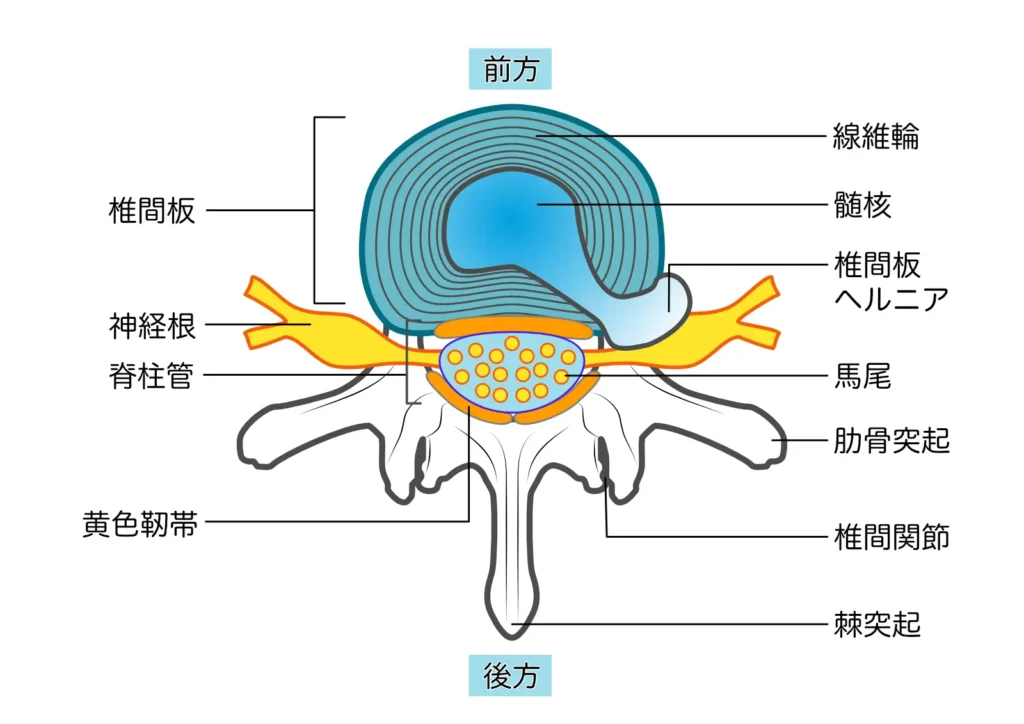 腰椎椎間板ヘルニアによる神経根圧迫の解剖図