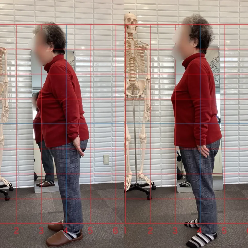 慢性腰痛の患者さんの姿勢変化（施術前後）猫背と骨盤後傾が改善した例｜鹿児島の整体