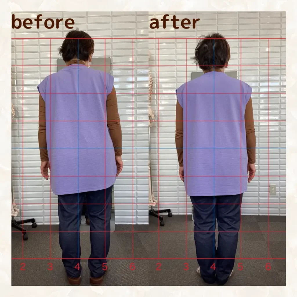 慢性腰痛・股関節痛の患者さんの姿勢改善（背面）ビフォーアフター｜肩の高さと体の傾きが整った例｜鹿児島整体