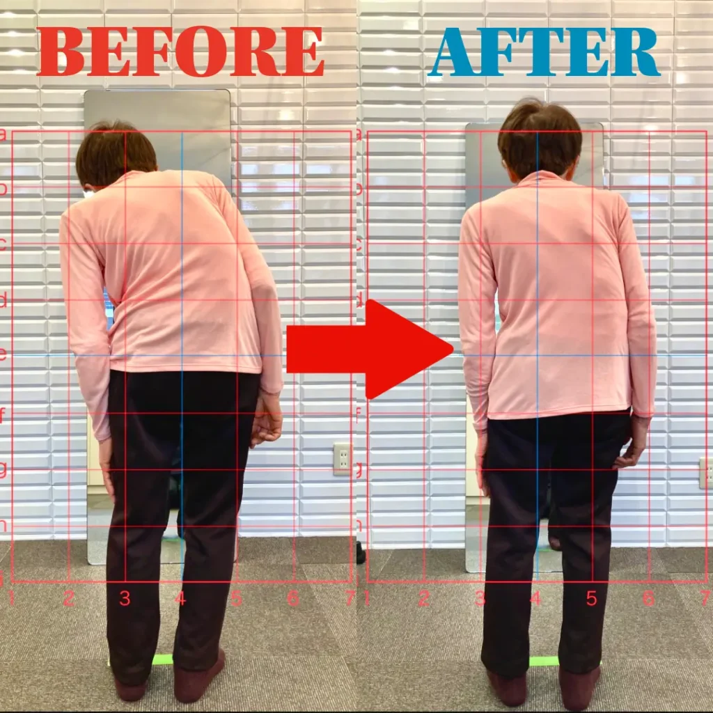 側弯姿勢の改善例（施術前後）体の傾きと背骨のラインが整ったケース｜鹿児島の整体