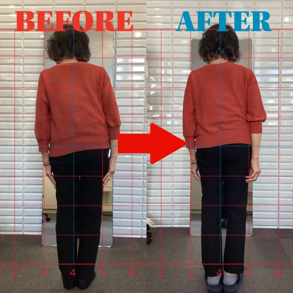 脊柱管狭窄症による姿勢バランスの改善例｜鹿児島整体