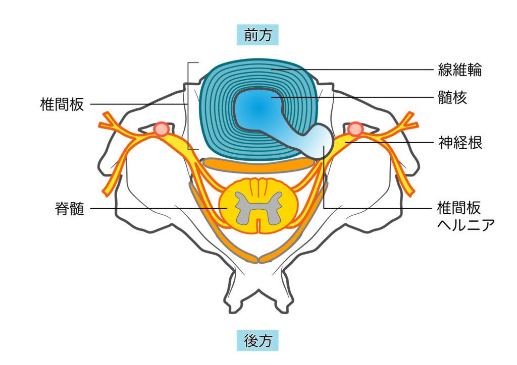 腰椎椎間板ヘルニアで飛び出した椎間板が神経根を圧迫する断面図