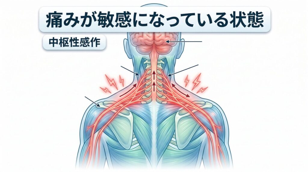 肩こりが慢性化する原因である中枢性感作のイメージ図