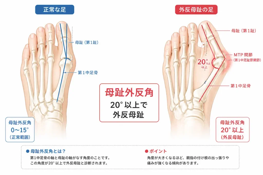 外反母趾の母趾外反角とMTP関節の図解