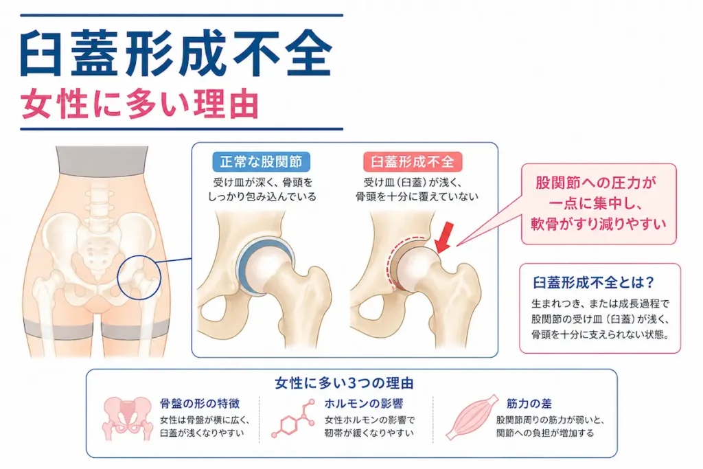 臼蓋形成不全による股関節の負担 女性に多い理由の図解