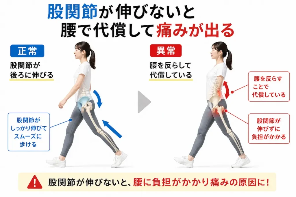 股関節伸展不足による歩行時の代償動作