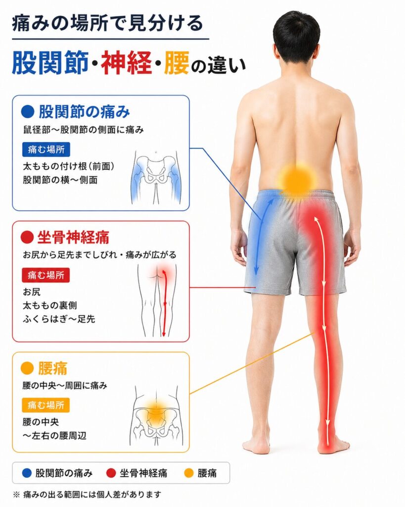 痛みの分布で見る股関節・坐骨神経・腰痛の違い