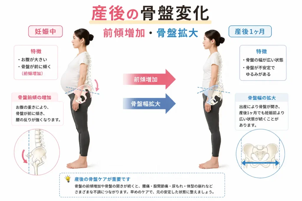 妊娠中と産後1ヶ月の骨盤の変化（前傾増加と骨盤幅の拡大）を示した図解