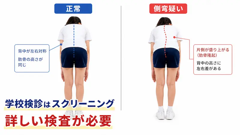 アダム前屈テスト 側弯症 チェック方法