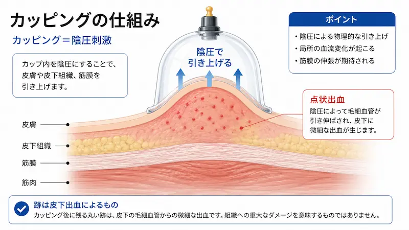 カッピングで皮膚や筋膜が陰圧で引き上げられる仕組みの図解