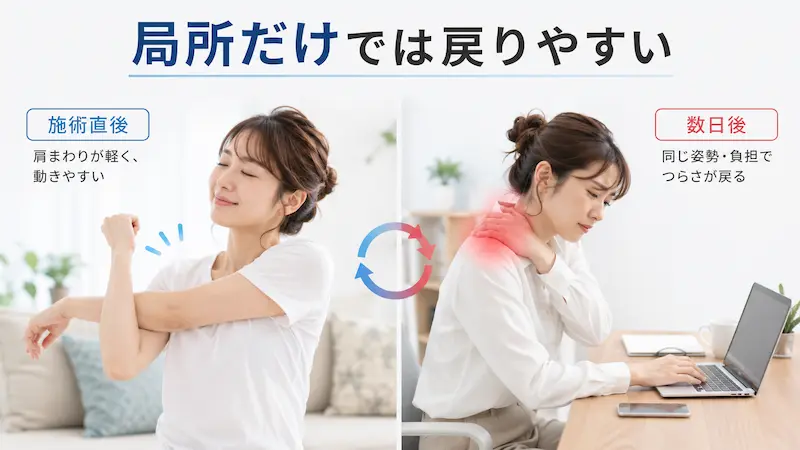 カッピング後に楽になっても姿勢の影響で肩こりが戻るイメージ