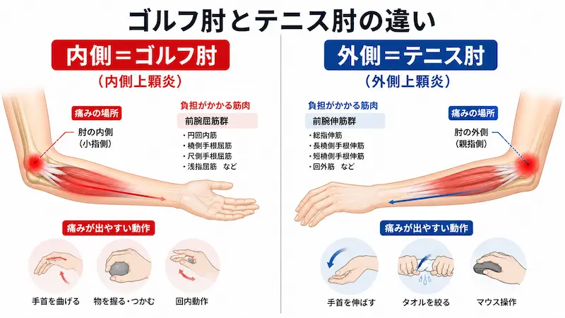 ゴルフ肘とテニス肘の違い(内側と外側の痛み)