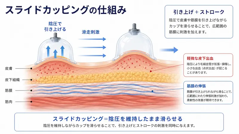 スライドカッピングで筋膜を引き上げながら滑らせる仕組み