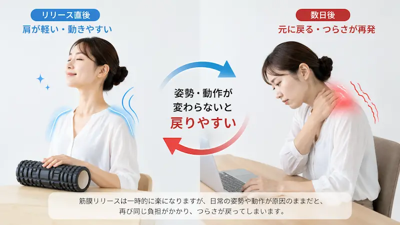 筋膜リリース後に肩こりが戻る原因のイメージ