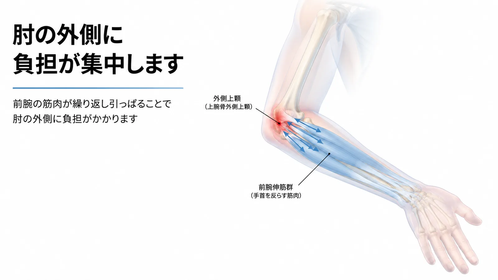 テニス肘で負担がかかる外側上顆と前腕伸筋群の図解