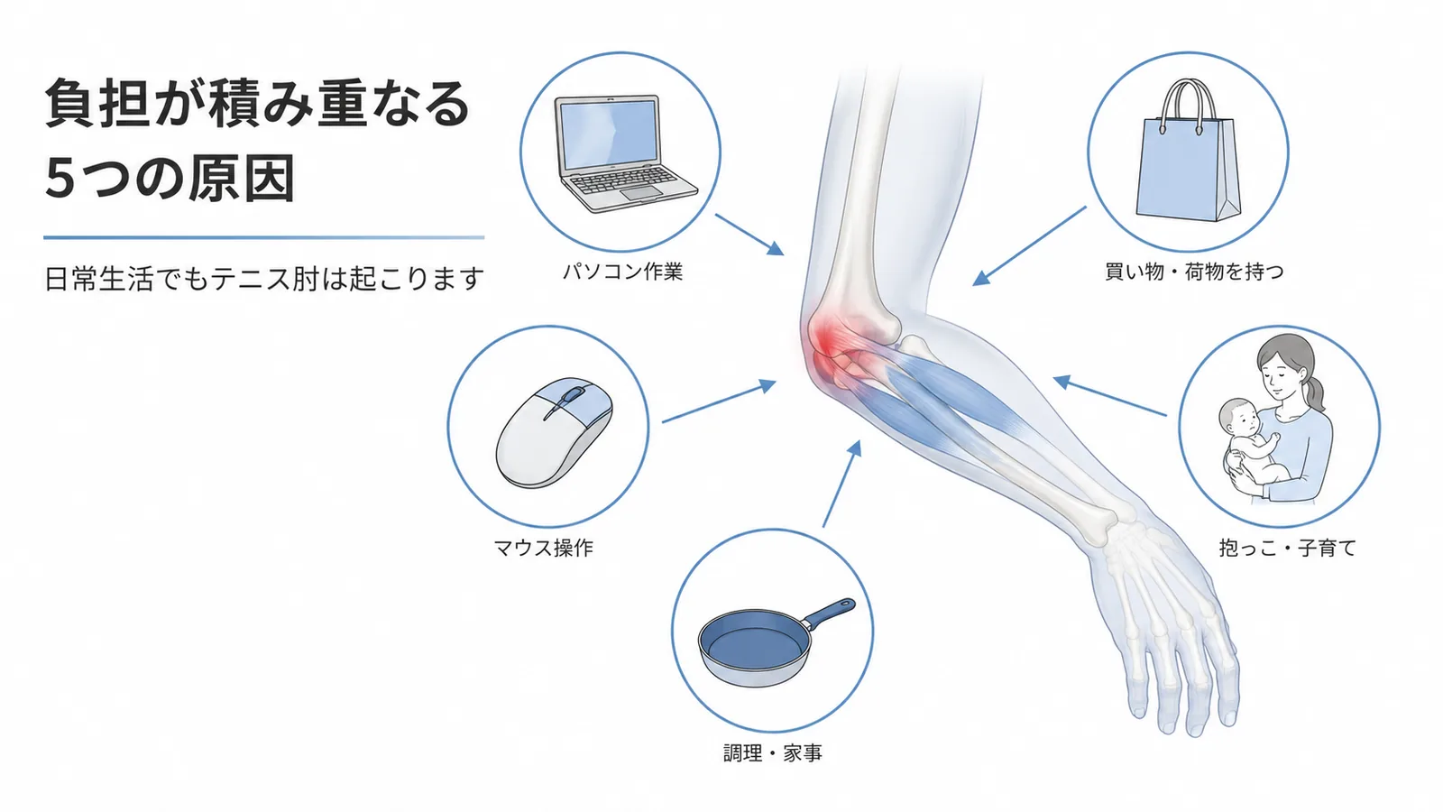 パソコンや家事、抱っこなどテニス肘につながる日常動作の図解