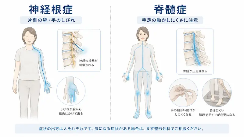 頚椎症性神経根症と頚椎症性脊髄症の違いを説明する図解