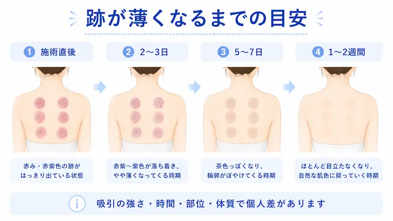 カッピング跡が施術直後から1〜2週間かけて薄くなる経過を示した図解