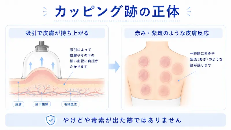 カッピングの吸引で皮膚が持ち上がり、赤みや紫斑のような跡が出る仕組みを説明する図解