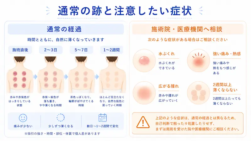 通常のカッピング跡の経過と、水ぶくれや強い痛みなど相談したい症状を比較した図解