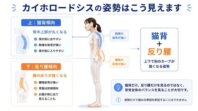 カイホロードシスで上半身の猫背傾向と下半身の反り腰傾向を示した図解